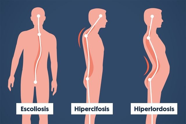 malas posturas espalda escoliosis hipercifosis hiperlordosis