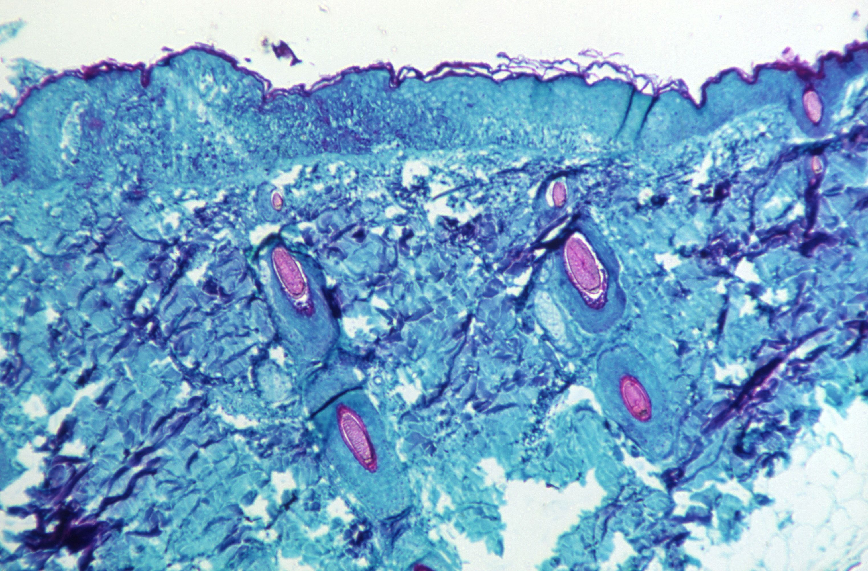 Una sección de tejido de la piel, extraída de una lesión en la piel de un mono que había sido infectado con el virus de la viruela del mono, se ve con un aumento de 50X en el cuarto día del desarrollo de la erupción en 1968.