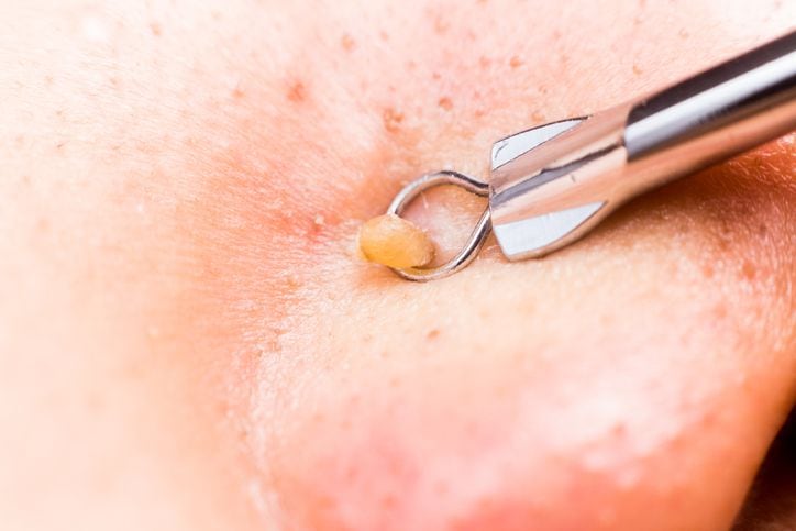 Extracting pimple blackheads from the nose with a tool