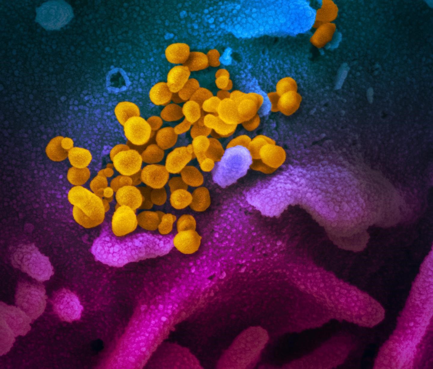 Imagen de microscopio electrónico de barrido muestra SARS-CoV-2 (amarillo), también conocido como 2019-nCoV, el virus que causa COVID-19, aislado de un paciente en los EE. UU. ) cultivados en el laboratorio.