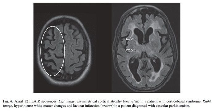 cerebro parkinson