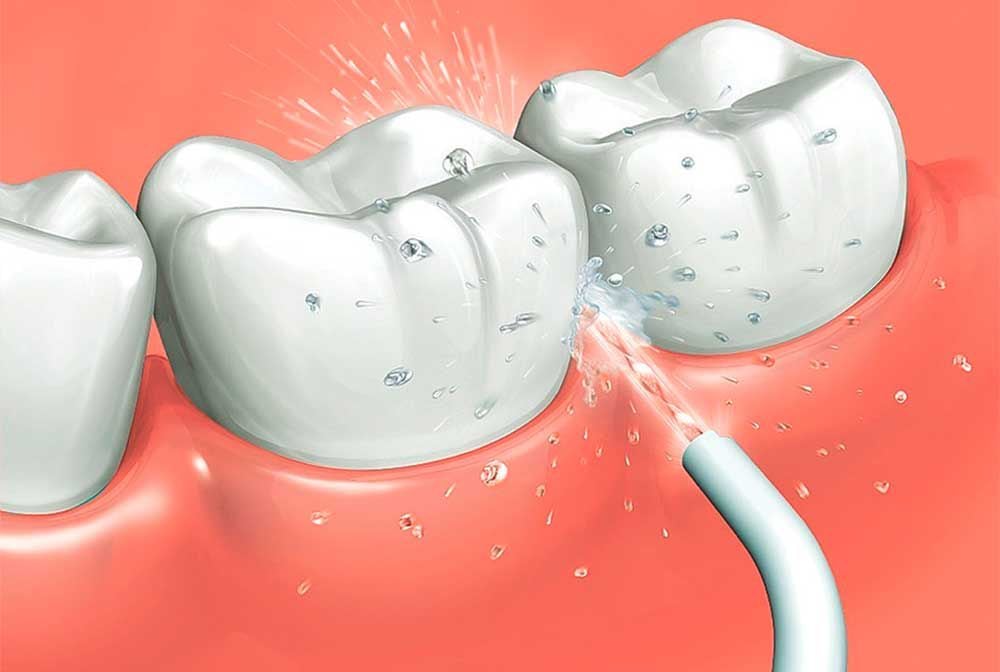 irrigador dental bucal higiene