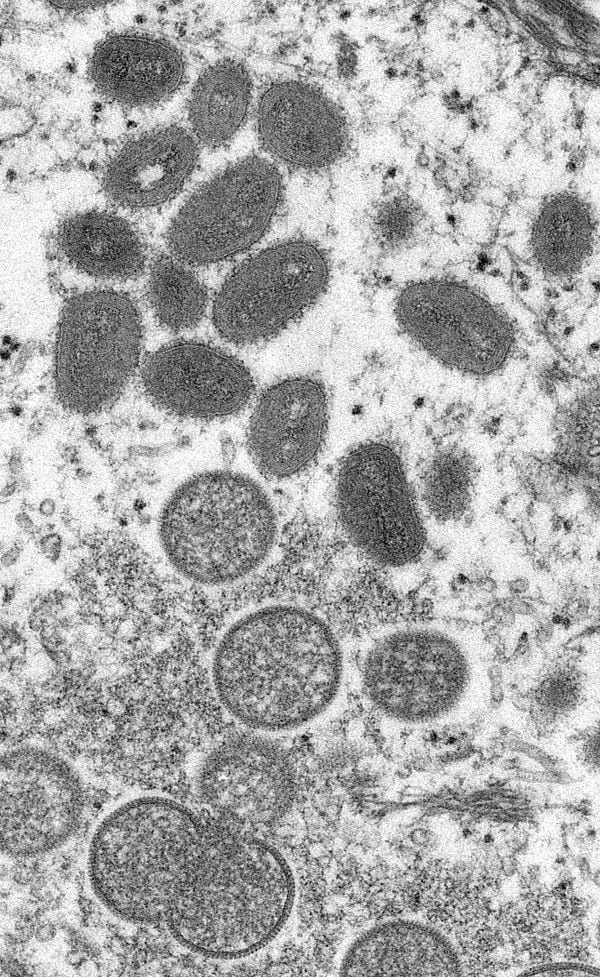 CDC microscopic image shows monkeypox virus particles