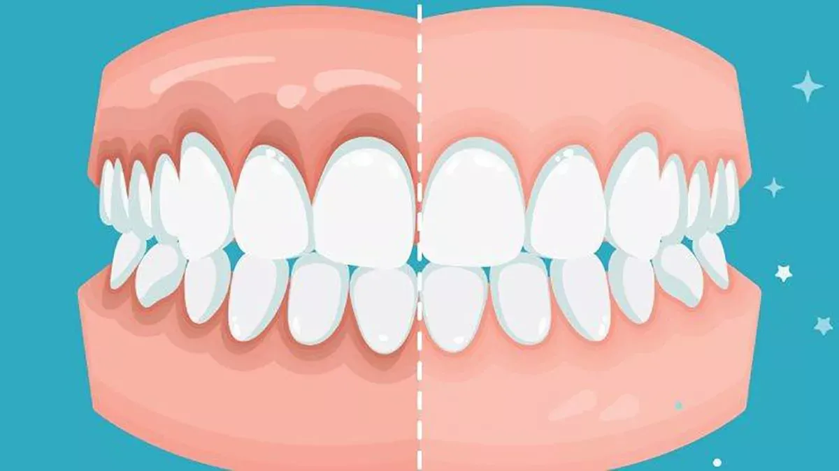 Periodontitis: cómo saber si tienes problemas de higiene bucal