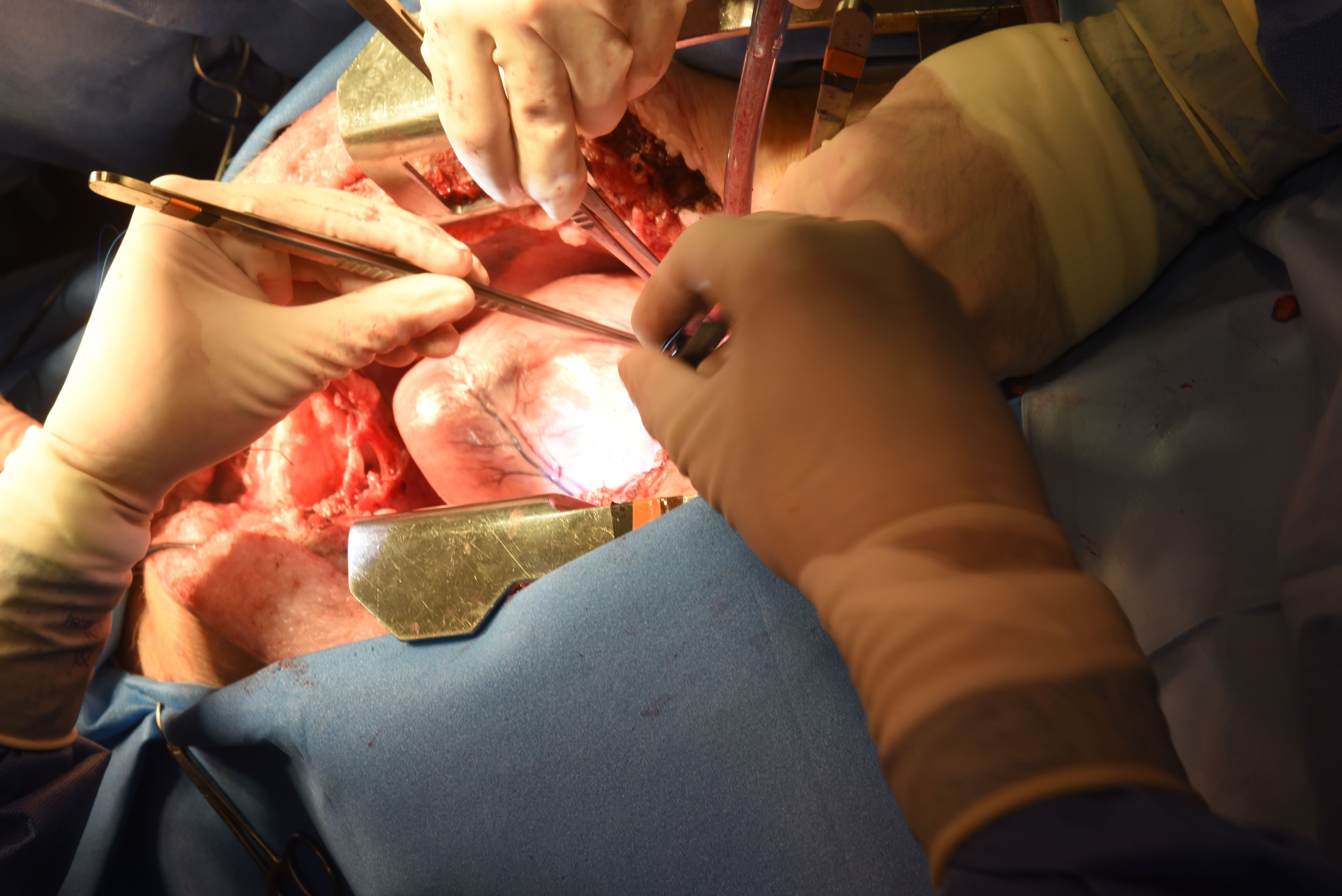 Medical First Sees Pig’s Heart Successfully Transplanted Into A Human