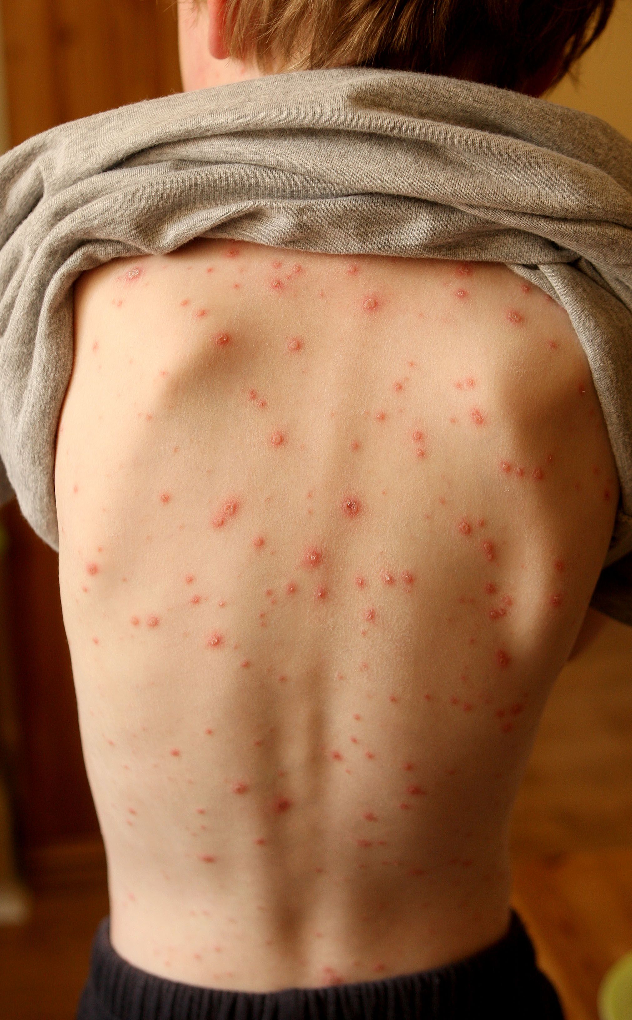 Chicken pox