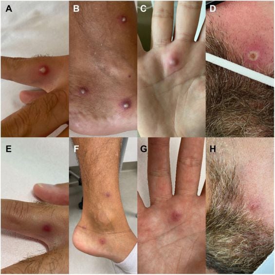 viruela del mono, primer caso de hombre con covid, viruela del mono y VIH