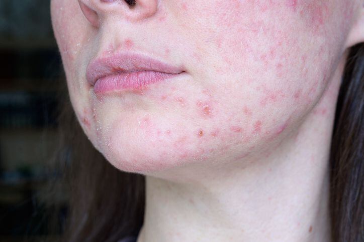 peeling of the skin, papules, pustules, post-acne, erythema in the lower third of the face of a patient with rosacea on a course of systemic retinoids. Chin, lips and cheek close up