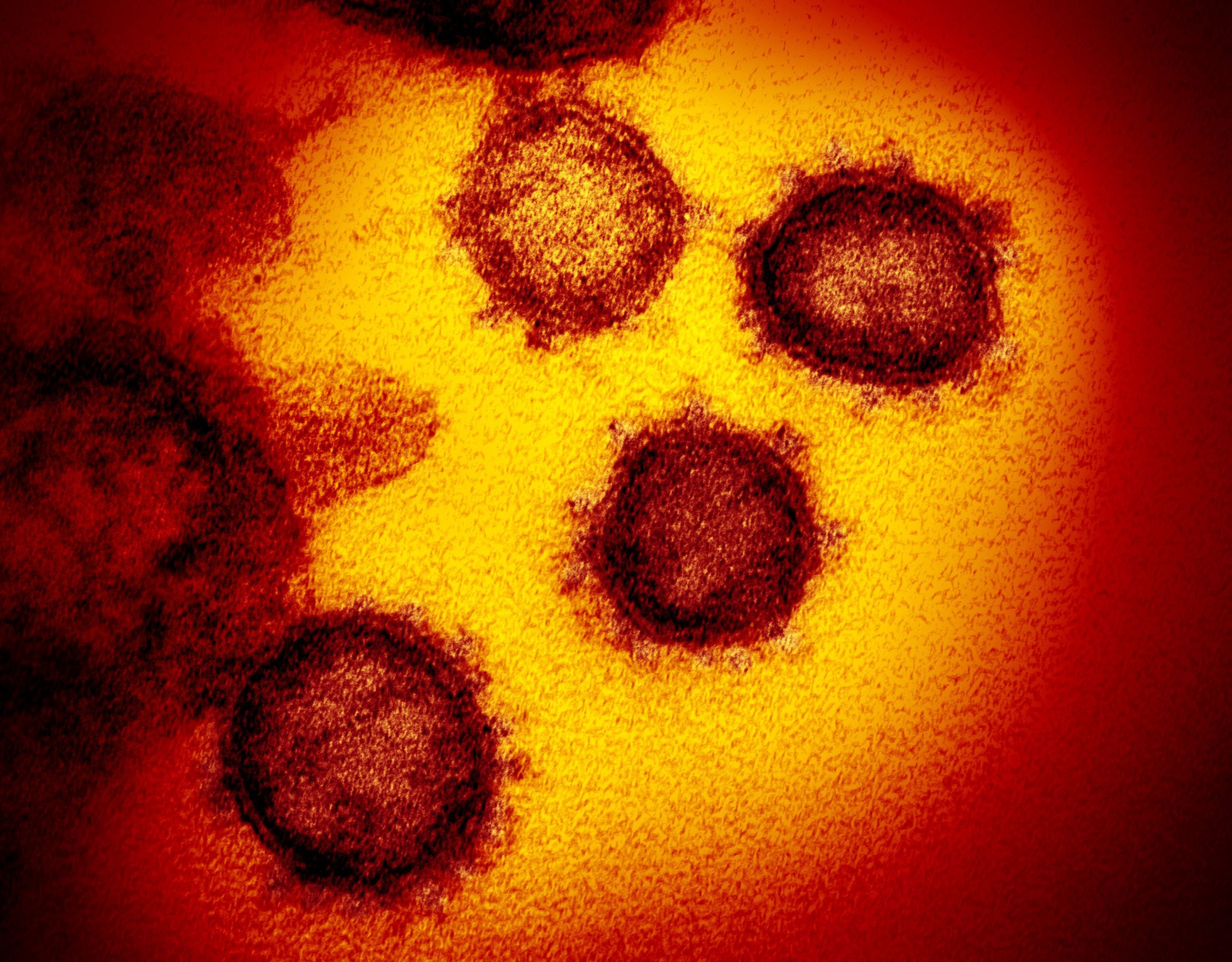 Transmission electron microscope image shows SARS-CoV-2, also known as novel coronavirus