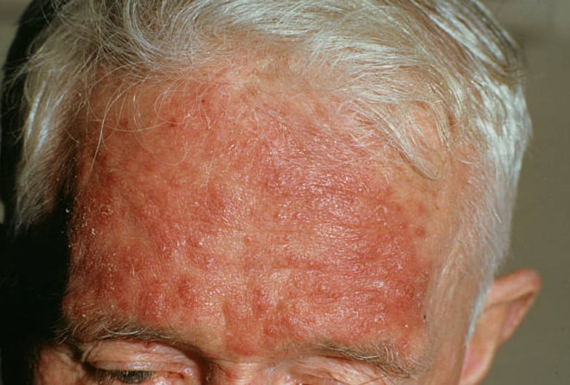 Rosacea